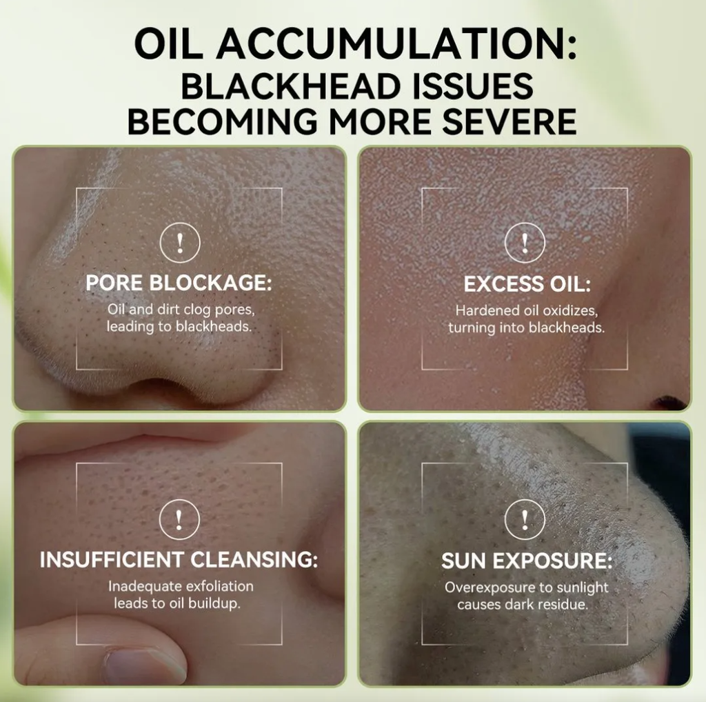 3.0 Máscara Facial Removedora De Cravos 30g Charcoal
